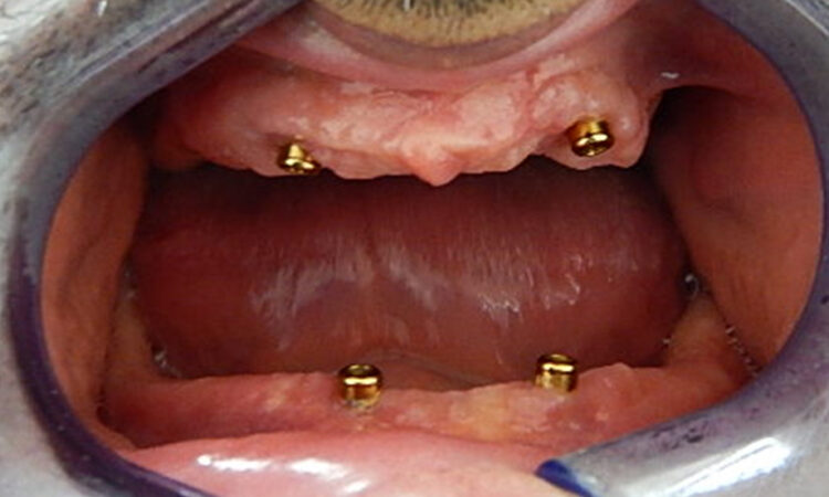 Before - puredental