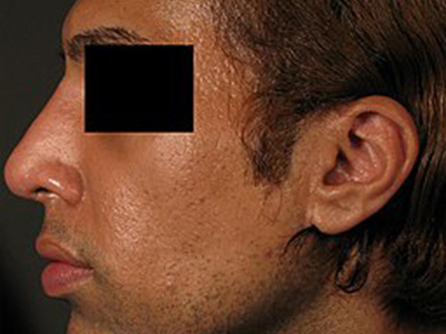 After - puredental