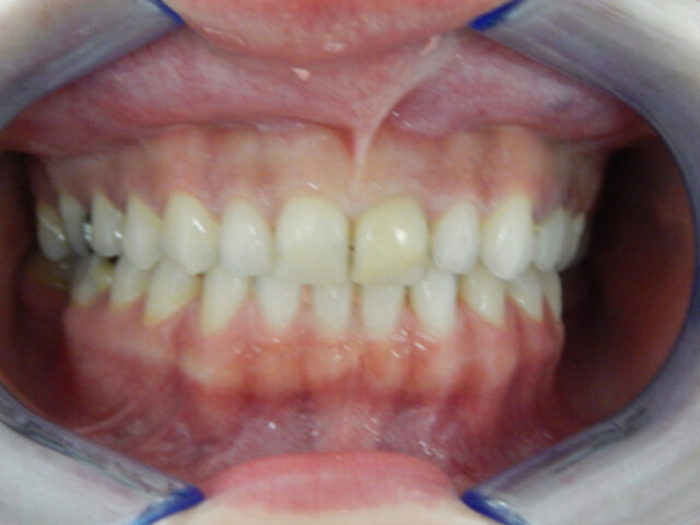 Before - puredental