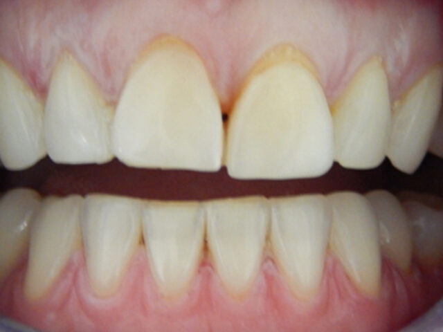 Before - puredental