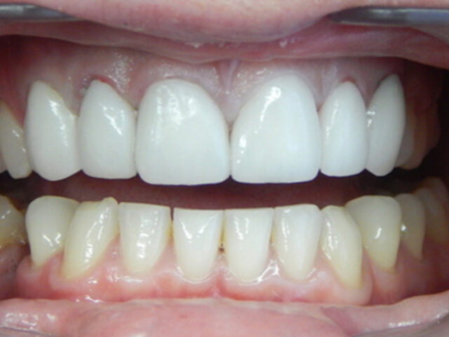 After - puredental
