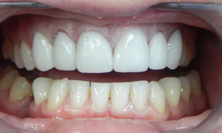 After - puredental