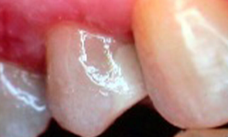 After - puredental