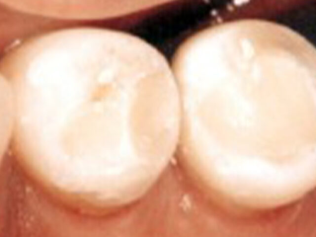 After - puredental