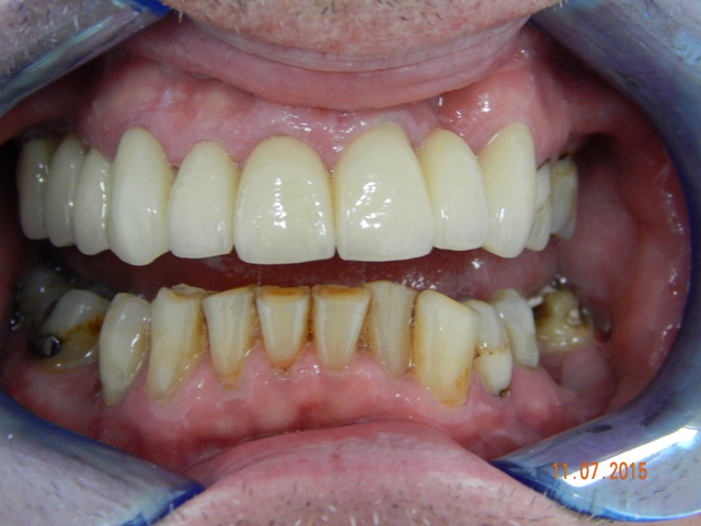 After - puredental