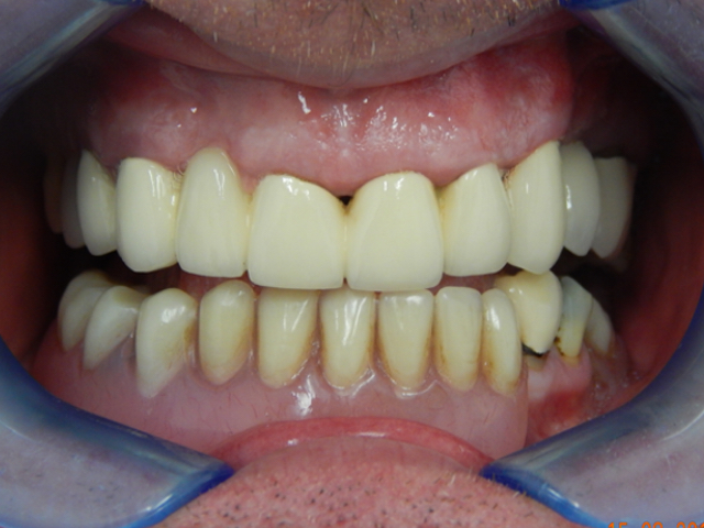 After - puredental