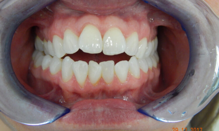 Before - puredental