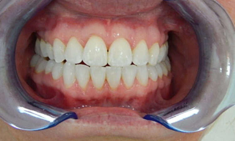 After - puredental