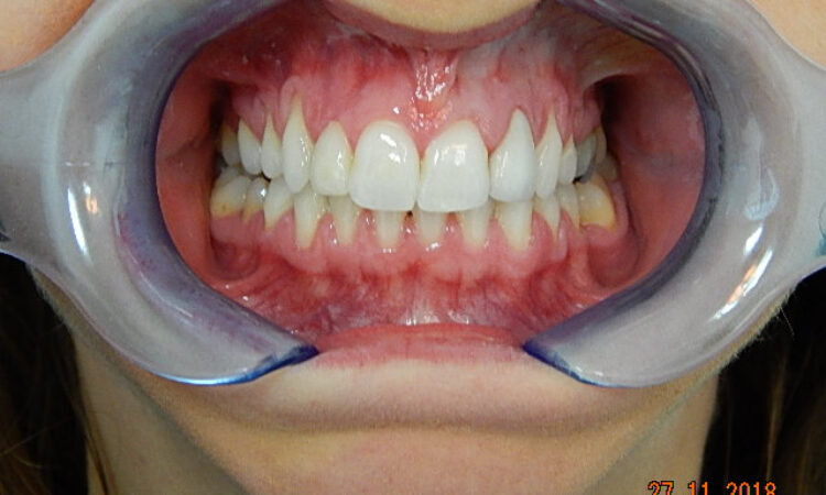 After - puredental