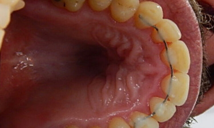 After - puredental
